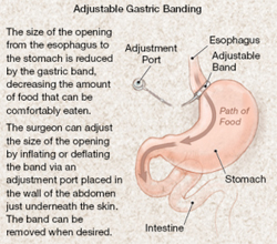 Laparoscopic Gastric Banding